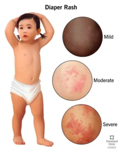 Causes of Diaper Rash